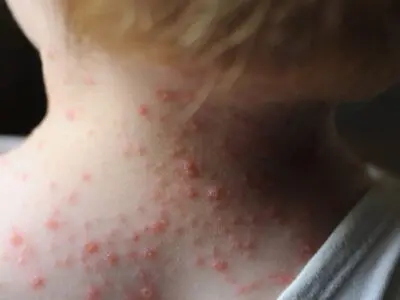شیوع آبله مرغان در بهار