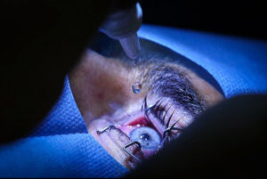 ردپای یک مقام سابق در جراحی ممنوعه؛ اعزام بیماران ایرانی به عمان برای تغییر رنگ چشم