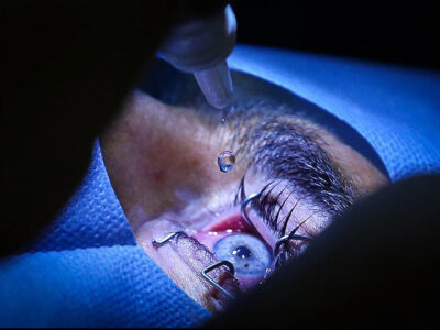 ردپای یک مقام سابق در جراحی ممنوعه؛ اعزام بیماران ایرانی به عمان برای تغییر رنگ چشم